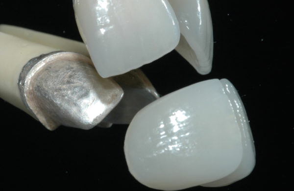 protesi-dentale-fissa-2